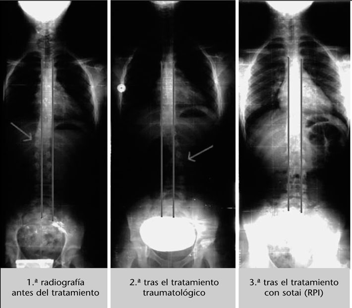 Sotai Reeducacion Postural Integral Sotai Su Eficacia En El Tratamiento De La Escoliosis